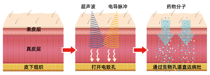 超声药物导入仪工作原理示意图